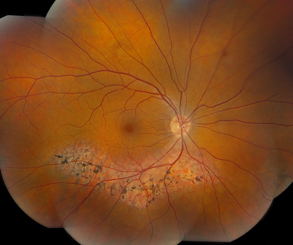 Clinical eye photograph illustrating Retinitis Pigmentosa Treatment Advances