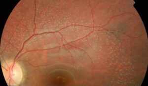 Clinical eye photograph illustrating Retinitis Punctata Albescens White Dots