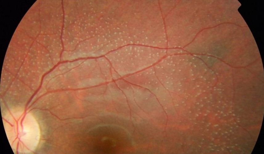 Clinical eye photograph illustrating Retinitis Punctata Albescens White Dots