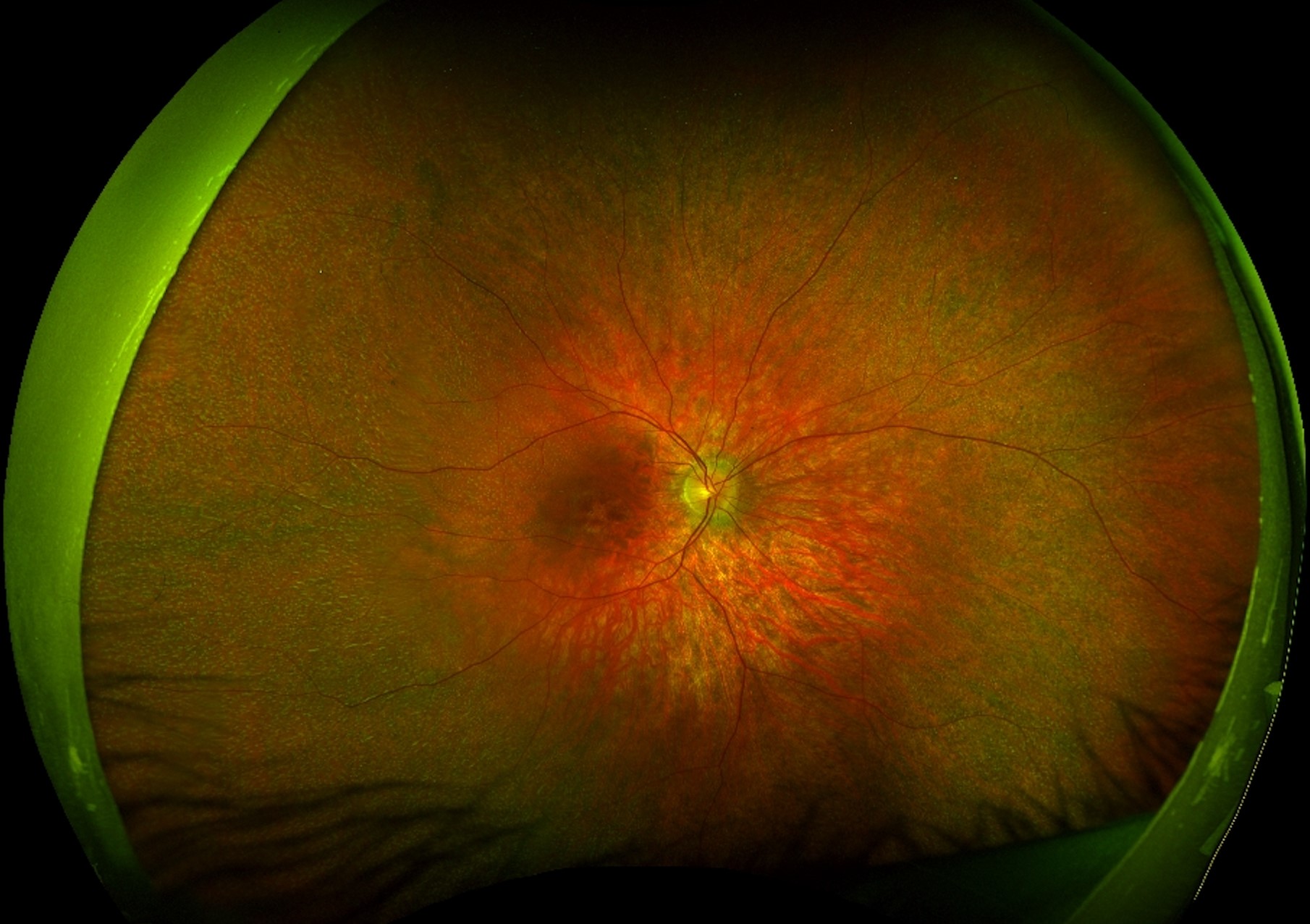 Clinical eye photograph illustrating Retinitis Punctata Albescens White Dots