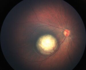 Clinical eye photograph illustrating Retinoblastoma Treatment Chemotherapy Laser