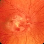 Clinical eye photograph illustrating Rickettsial Retinitis