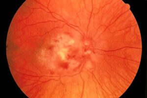 Clinical eye photograph illustrating Rickettsial Retinitis