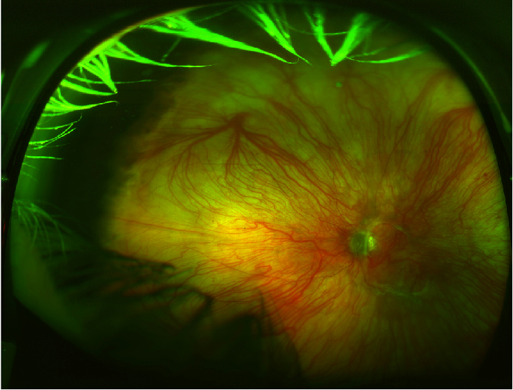 Clinical eye photograph illustrating Rpe Tear After Anti Vegf Risk Factors Management