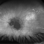 Clinical eye photograph illustrating Salt and Pepper Fundus Causes Differential