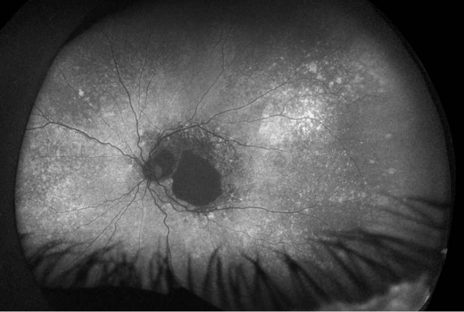 Clinical eye photograph illustrating Salt and Pepper Fundus Causes Differential