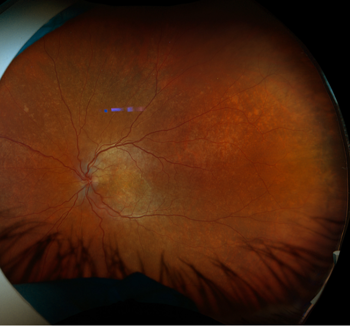 Clinical eye photograph illustrating Salt and Pepper Fundus Causes Differential