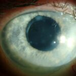 Clinical eye photograph illustrating Salzmann Nodular Degeneration Management