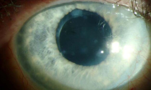 Salzmann Nodular Degeneration: Peripheral Nodules That Are Neither Inflammatory Nor Dangerous