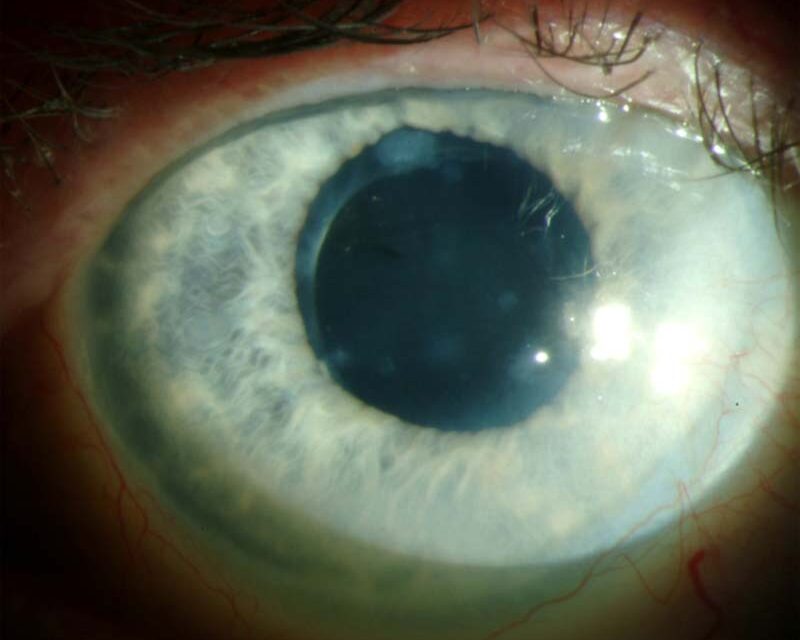 Salzmann Nodular Degeneration: Peripheral Nodules That Are Neither Inflammatory Nor Dangerous
