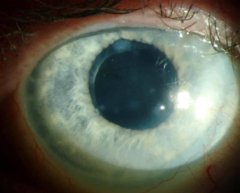 Clinical eye photograph illustrating Salzmann Nodular Degeneration Management