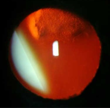 Clinical eye photograph illustrating Salzmann Nodular Degeneration Management