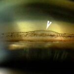 Clinical eye photograph illustrating Sampaolesi Line
