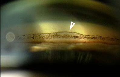 Sampaolesi Line: The Wavy Pigment Band on the Trabecular Meshwork in Pseudoexfoliation