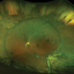 Clinical eye photograph illustrating Scleral Buckle Complications