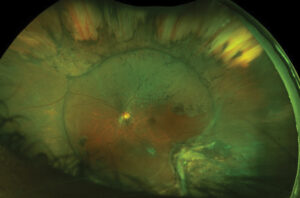 Clinical eye photograph illustrating Scleral Buckle Complications