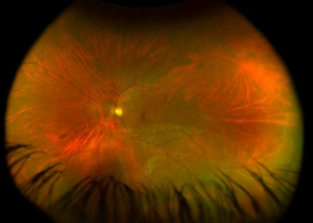 Clinical eye photograph illustrating Scleral Buckle vs Vitrectomy