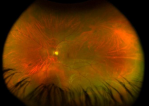 Clinical eye photograph illustrating Scleral Buckle vs Vitrectomy