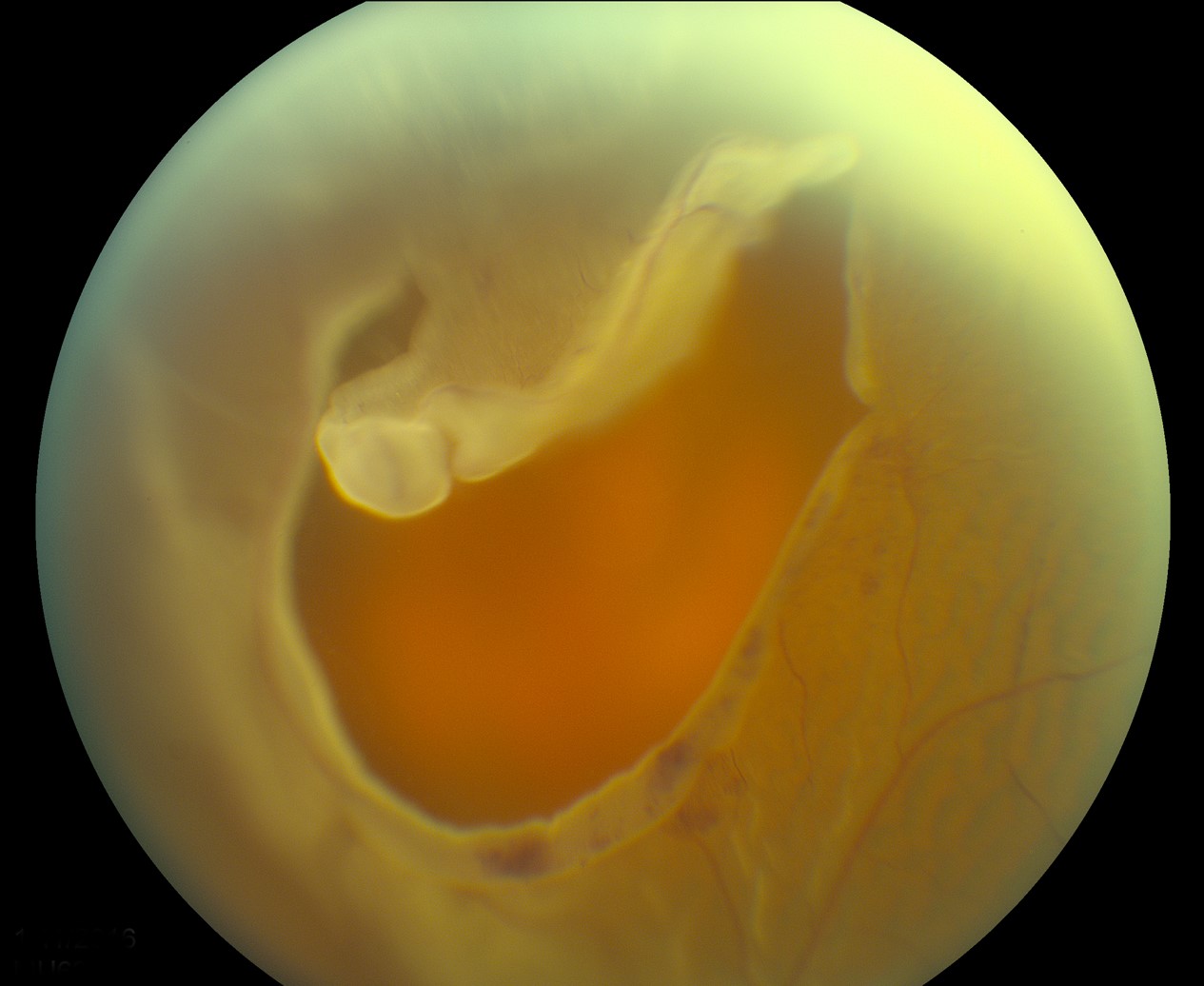 Clinical eye photograph illustrating Scleral Buckle vs Vitrectomy