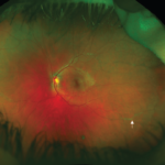 Clinical eye photograph illustrating Scleral Depression Technique