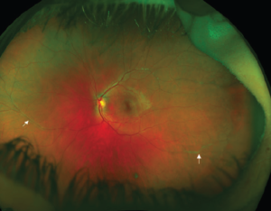 Clinical eye photograph illustrating Scleral Depression Technique