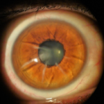 Clinical eye photograph illustrating Scleral Lens Complications