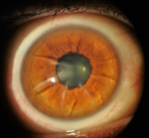 Clinical eye photograph illustrating Scleral Lens Complications