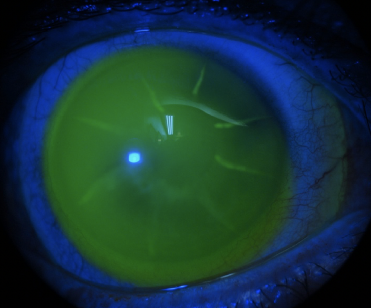 Clinical eye photograph illustrating Scleral Lens Complications