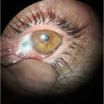 Clinical eye photograph illustrating Scleral Thinning Causes