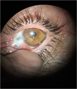 Clinical eye photograph illustrating Scleral Thinning Causes