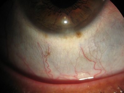 Clinical eye photograph illustrating Scleral Thinning Causes