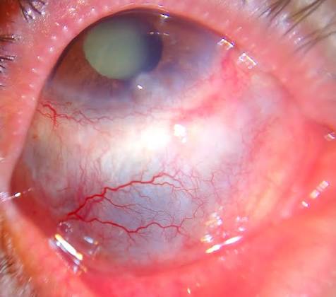 Scleritis Classification: Anterior, Posterior, and Why the Pattern Predicts the Workup