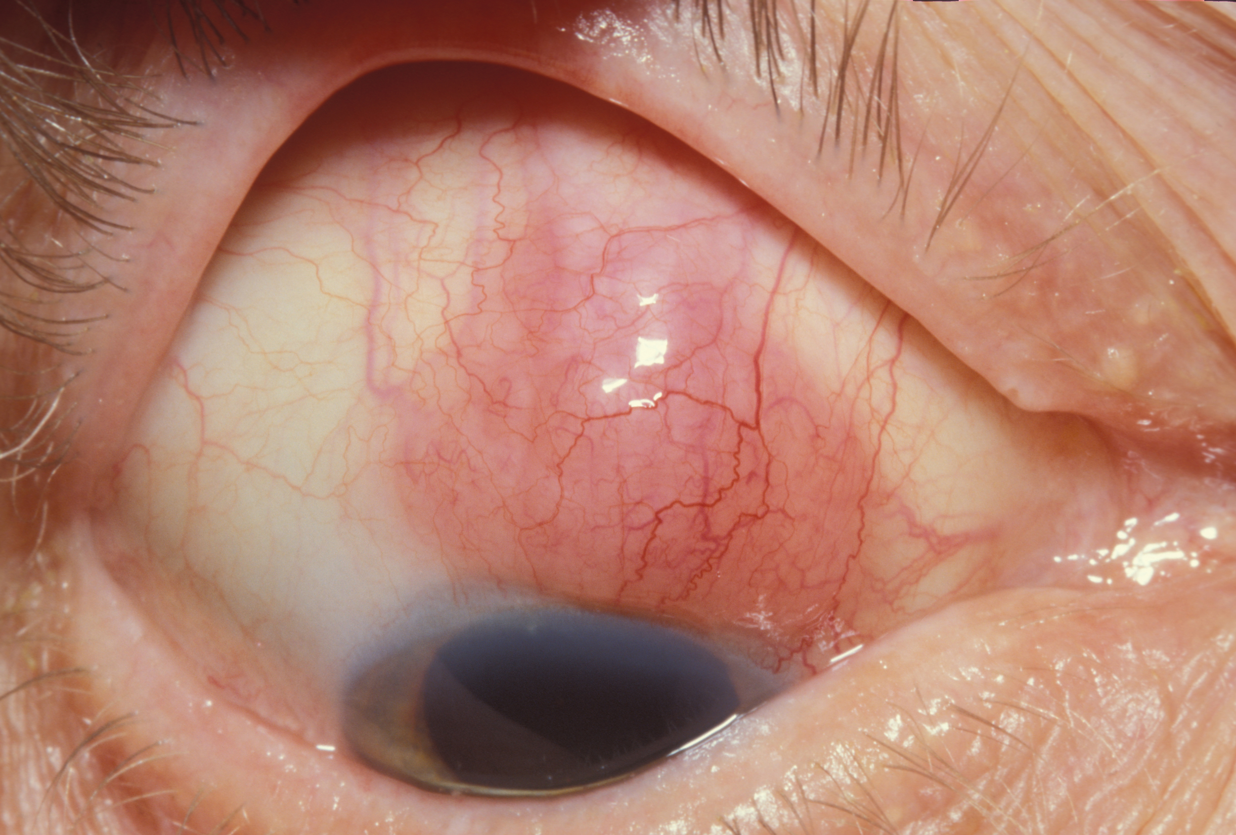 Clinical eye photograph illustrating Scleritis Classification Systemic Workup