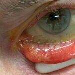 Clinical eye photograph illustrating Sebaceous Gland Carcinoma Eyelid Masquerade