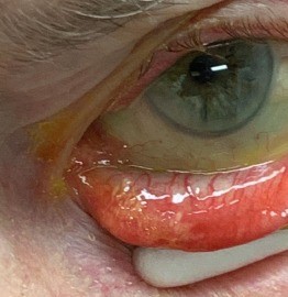 Sebaceous Gland Carcinoma: The Eyelid Tumor That Hides Behind a Chalazion