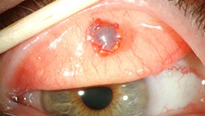 Clinical eye photograph illustrating Sebaceous Gland Carcinoma Eyelid Masquerade