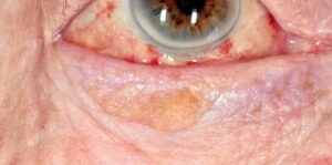 Clinical eye photograph illustrating Seborrheic Keratosis Eyelid
