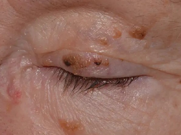 Clinical eye photograph illustrating Seborrheic Keratosis Eyelid