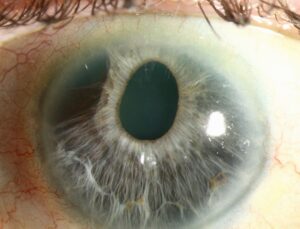Clinical image illustrating Sectoral Iris Atrophy (Iris Patch Loss)