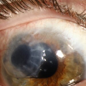 Clinical eye photograph illustrating Senile Corneal Furrow Degeneration