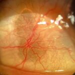 Clinical eye photograph illustrating Senile Scleral Plaque