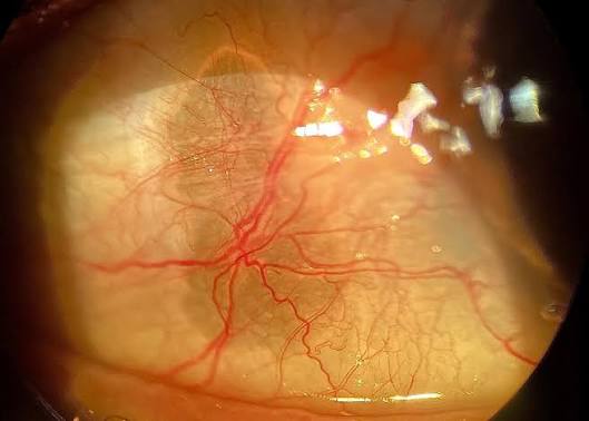 Senile Scleral Plaque: The Gray Patch in Front of the Rectus Muscle Insertion That Needs No Treatment