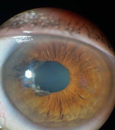 Clinical eye photograph illustrating Senile Scleral Plaque
