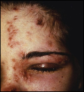 Clinical image illustrating Shingles Vaccine and Herpes Zoster Eye Disease