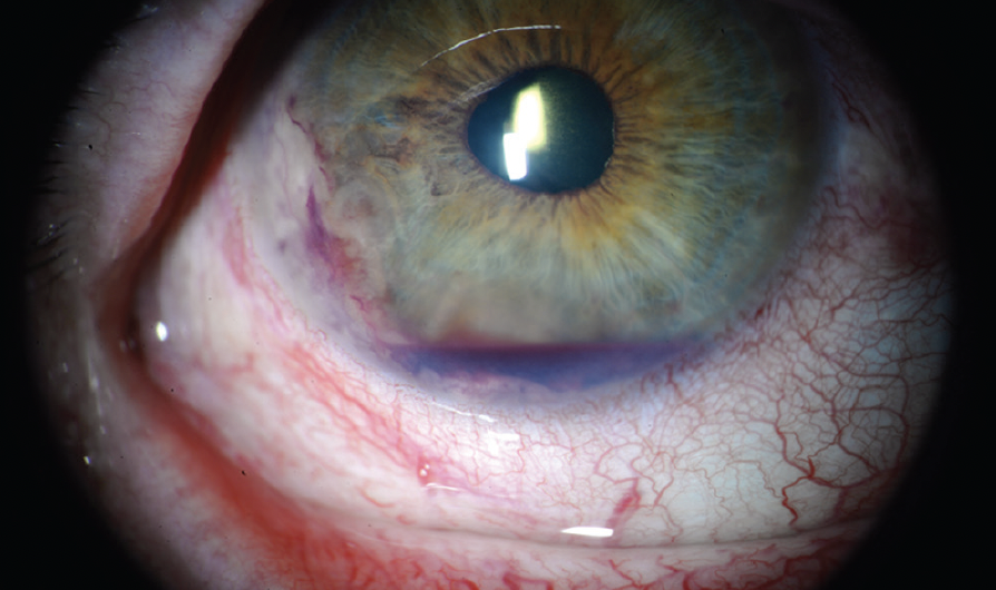 Sickle Cell Hyphema (Eye Bleed): Why IOP Is Riskier