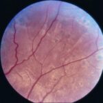 Clinical eye photograph illustrating Siegrist Streaks Hypertensive Choroidopathy