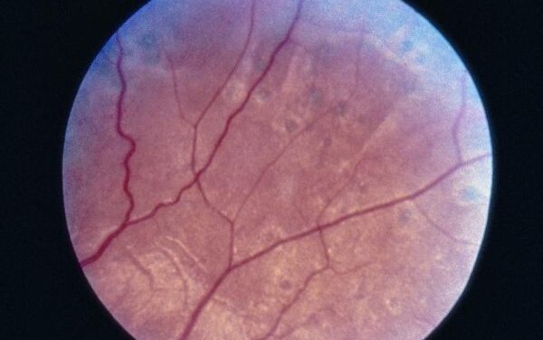 Siegrist Streaks: Linear Pigment Along Choroidal Vessels After Hypertensive Choroidopathy