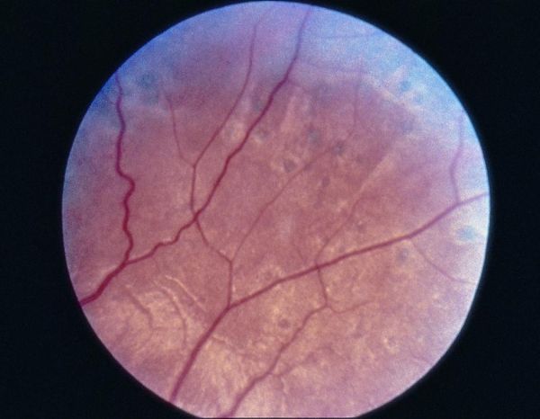 Siegrist Streaks: Linear Pigment Along Choroidal Vessels After Hypertensive Choroidopathy