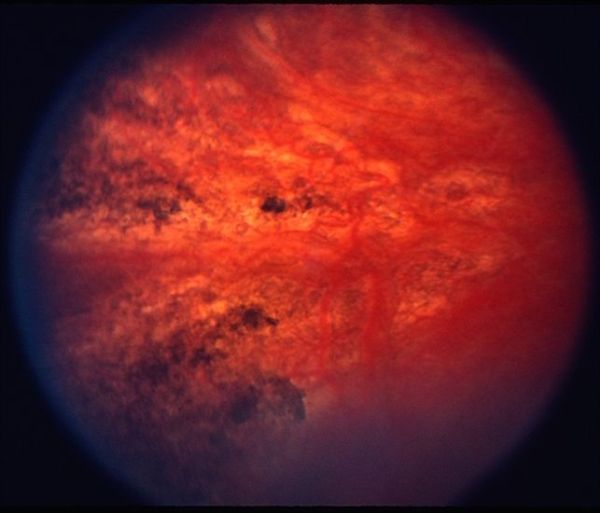 Clinical eye photograph illustrating Siegrist Streaks Hypertensive Choroidopathy