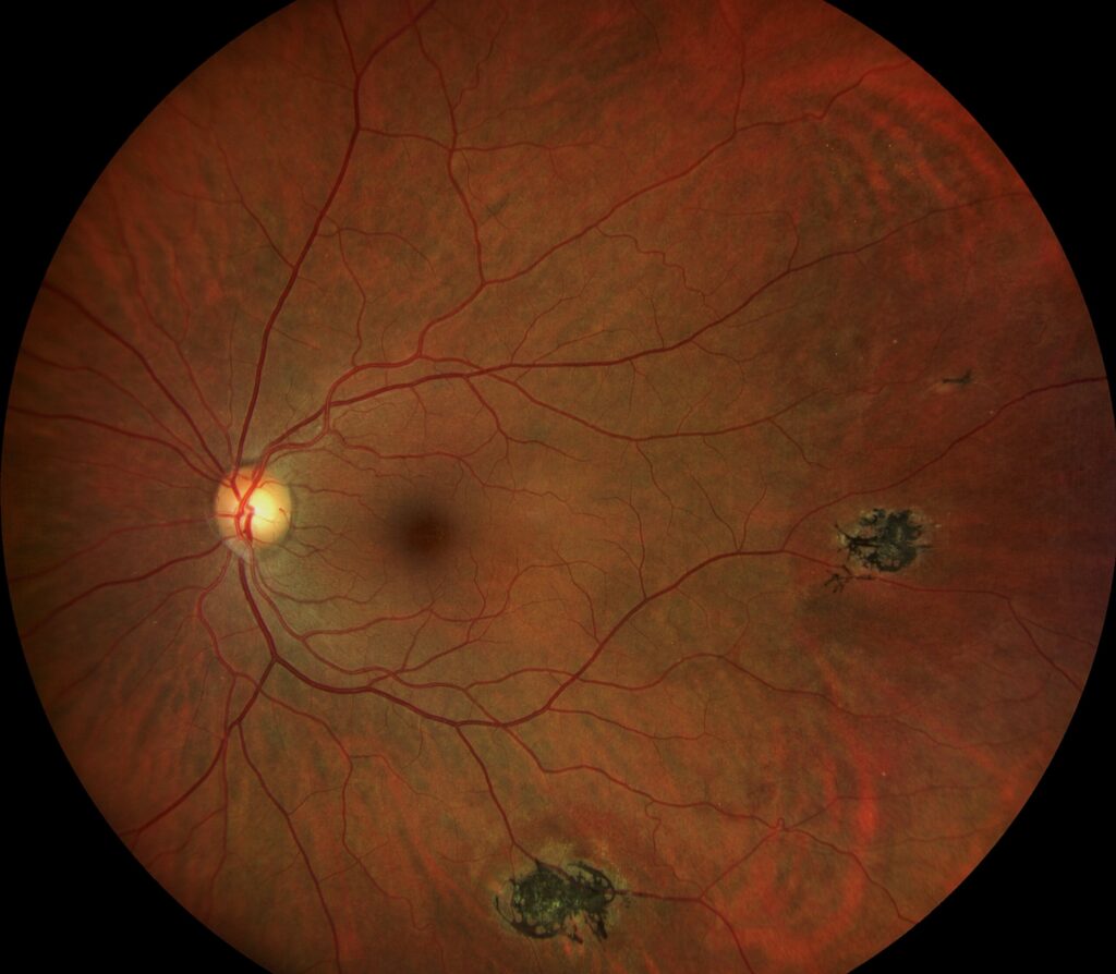Clinical eye photograph illustrating Sildenafil and the Retina Cyanopsia